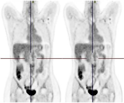 Case report: Clinical success targeting BRAF-mutated, hormone receptor positive, HER2- negative advanced breast cancer patient with BRAF-inhibitor plus MEK- inhibitor